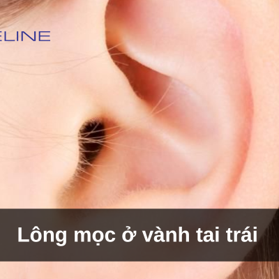 Hair growing on the left outer ear